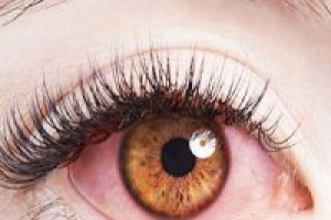 این علایم در چشمها نشانه چیست ؟